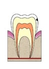 imagem evolução da cárie dental 2