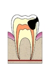 imagem evolução da cárie dental 4