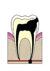 imagem evolução da cárie dental 5