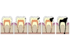 imagem evolução da cárie dental