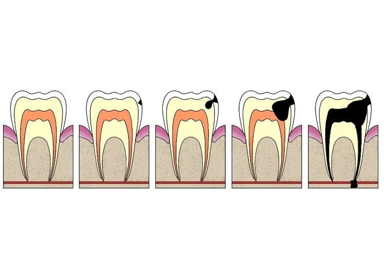 imagem a evoluÃ§Ã£o da cÃ¡rie 