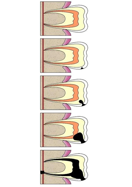 a evoluÃ§Ã£o da cÃ¡rie 