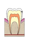 imagem evoluÃ§Ã£o da cÃ¡rie dental 2
