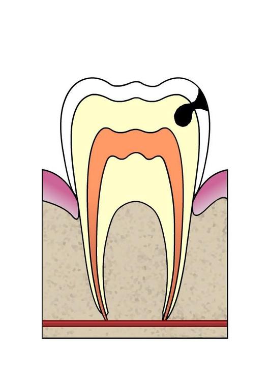 evoluÃ§Ã£o da cÃ¡rie dental 3
