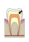 imagem evoluÃ§Ã£o da cÃ¡rie dental 3
