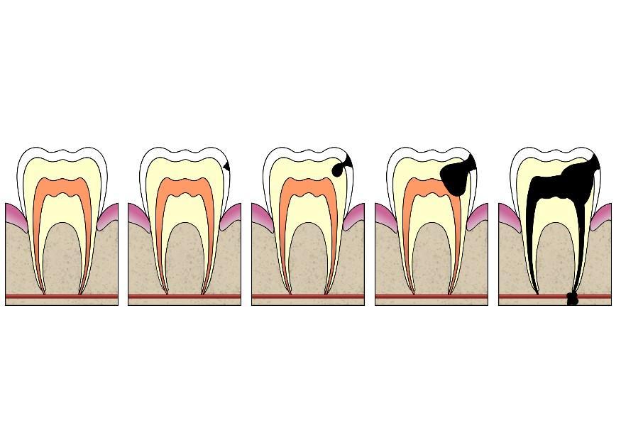 imagem a evoluA§A£o da cA¡rie 