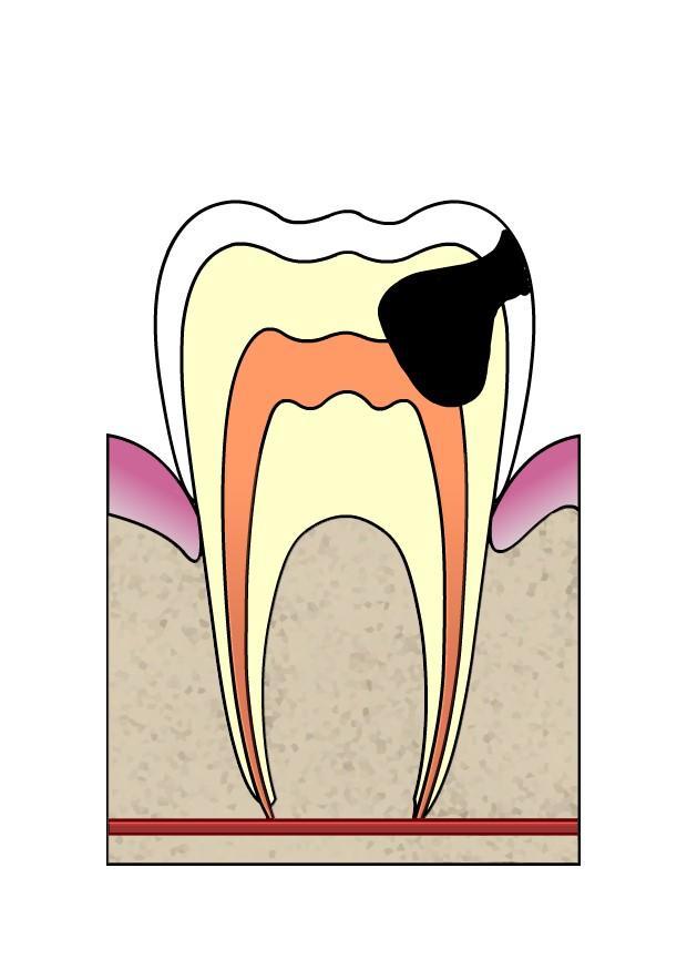 evoluA§A£o da cA¡rie dental 4 imagem evoluA§A£o da cA¡rie dental 4